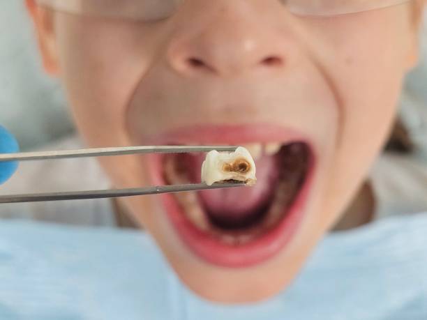 Best Emergency Dental Care for Broken or Chipped Teeth in Helena Valley Northeast, MT