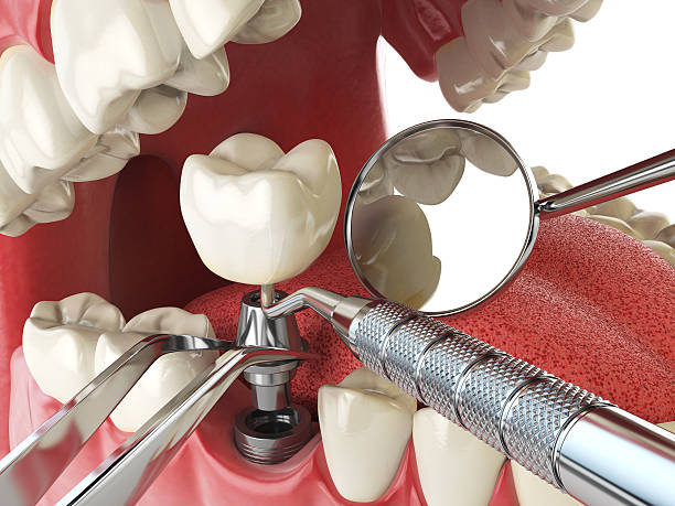 Best Emergency Dental Care for Broken or Chipped Teeth in Helena Valley Northeast, MT